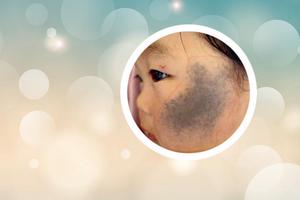 胎記在腿上，寓意人生獨特印記。